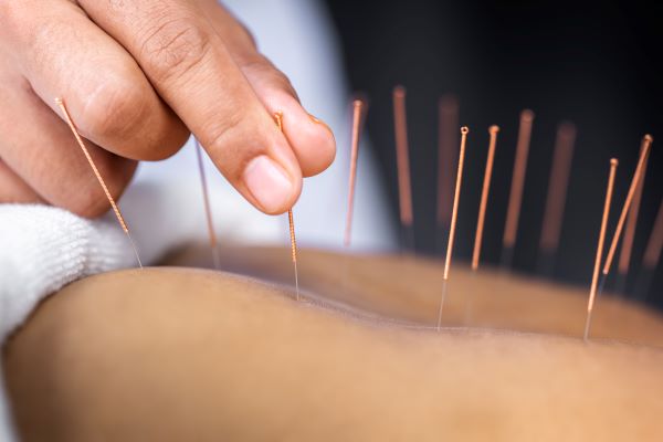 a hand applying acupuncture needles to someone's back