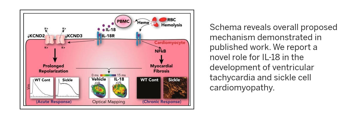 This schema shows mechanism of prolonged repolarization and acute response and Myocardial Fibrosis in Chronic Response. We report a novel role for interleukin-18 (IL-18) in the development of ventricular tachycardia and sickle cell cardiomyopathy. 