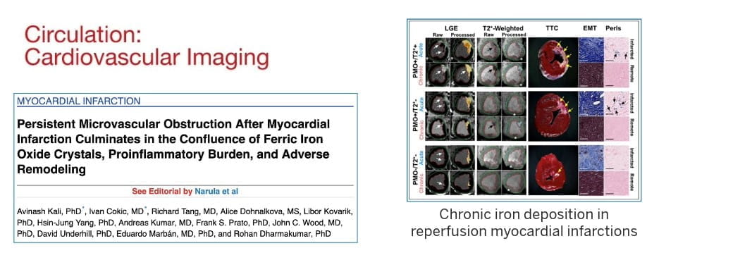 graphic from this publication shows chronic iron deposition in reperfusion myocardial infarctions