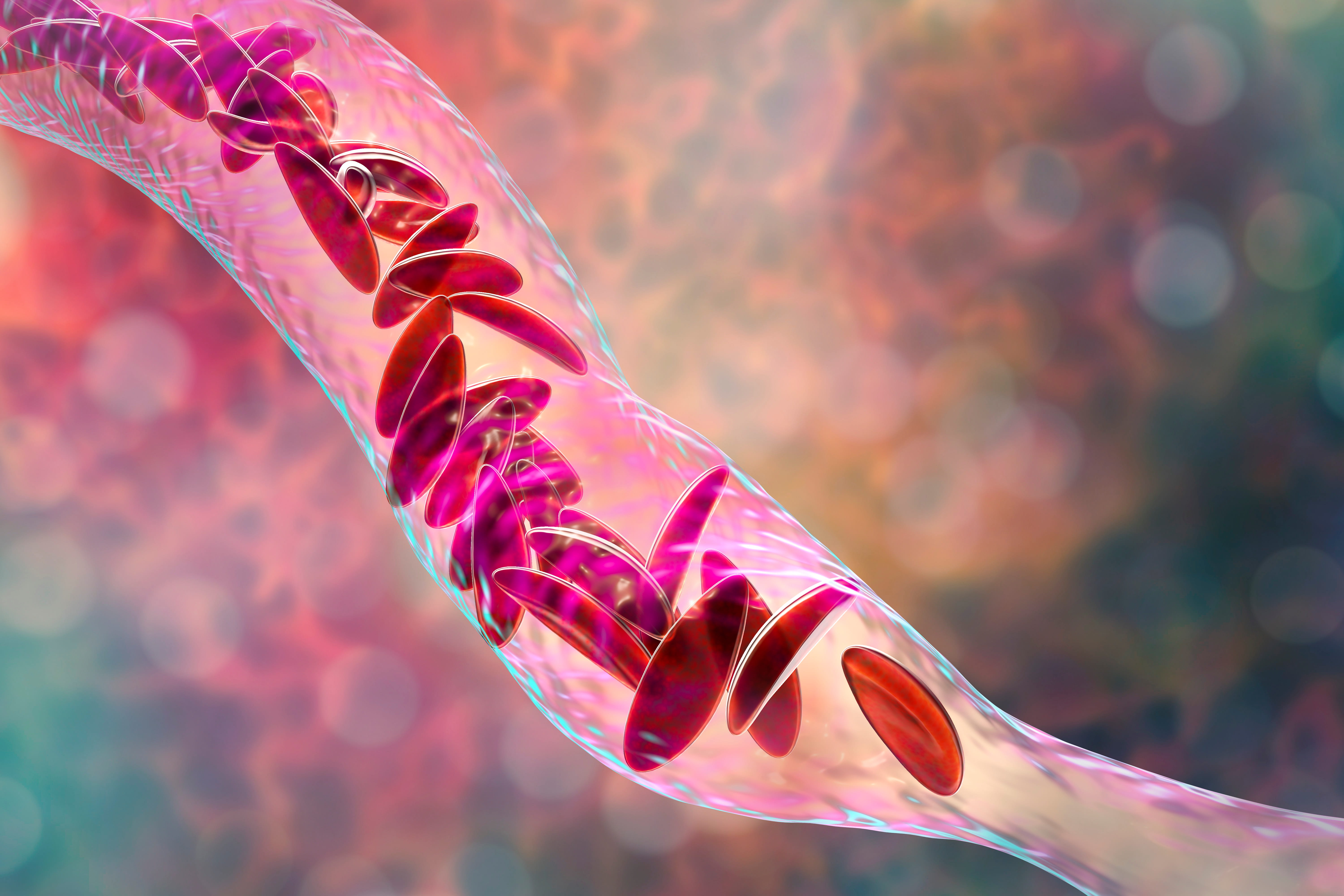 A 3D illustration of clumps of sickle cell blocking a blood vessel. 