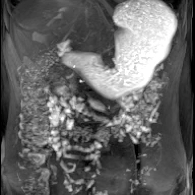 Photo of internal organs showing gastroparesis
