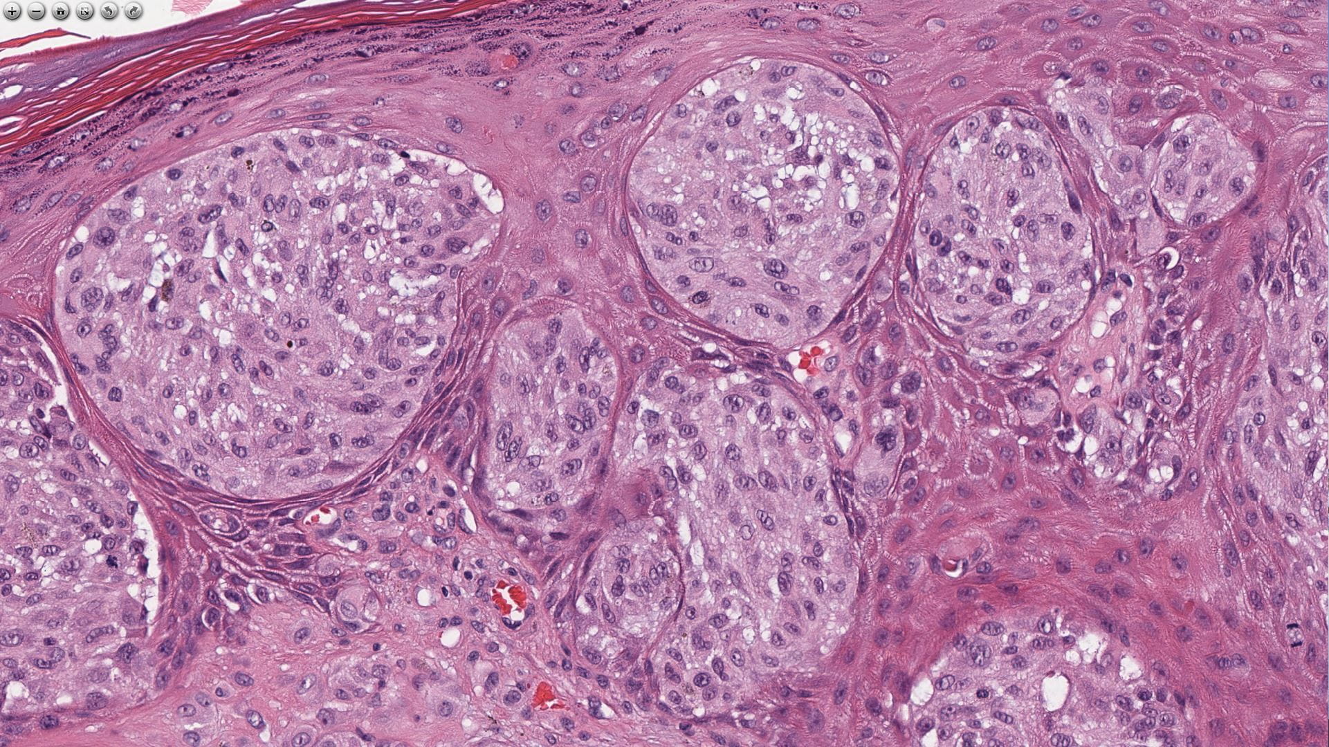 pathology slide showing cells in pink and blue