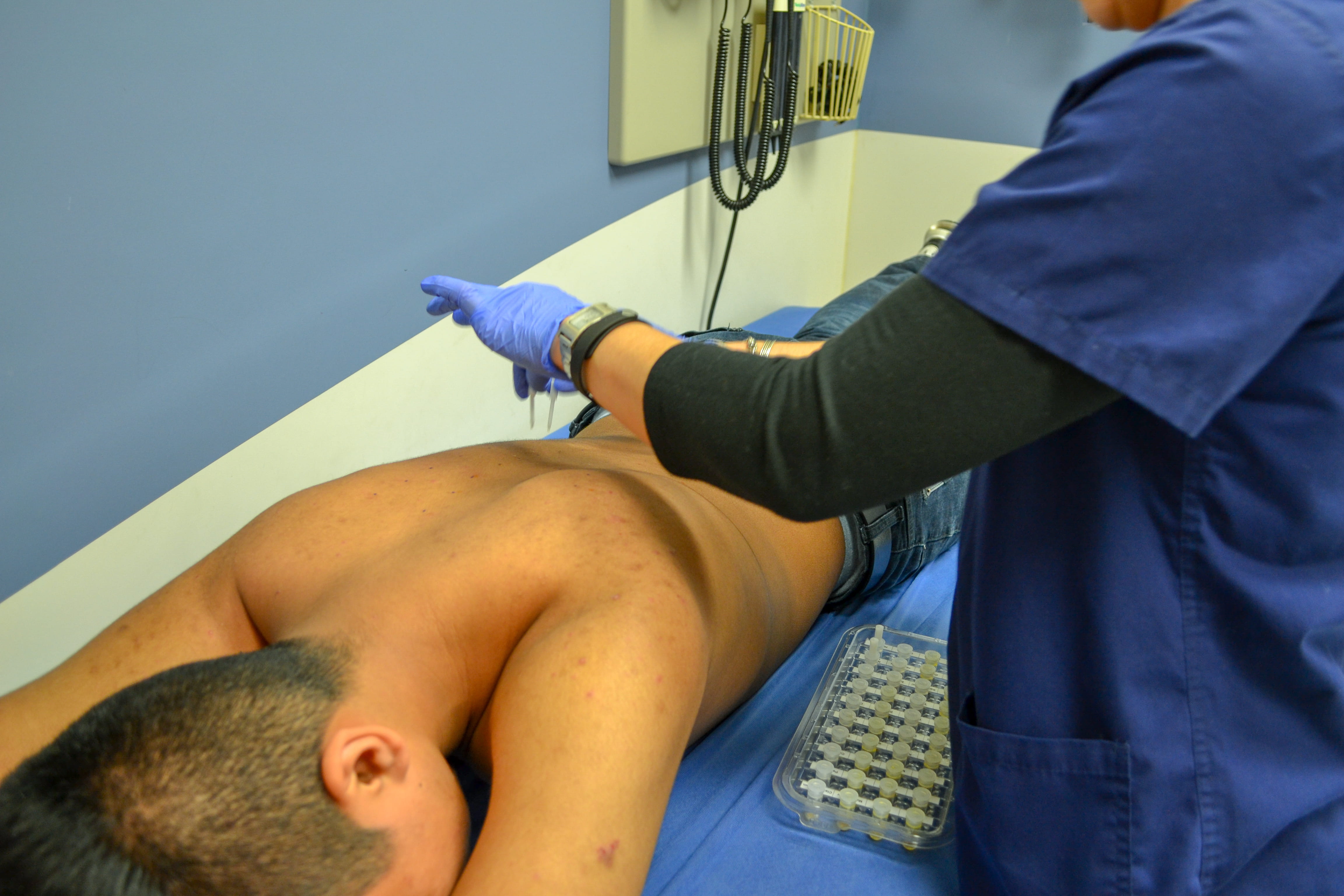 Skin prick testing at Riley Hospital for Children at IU Health