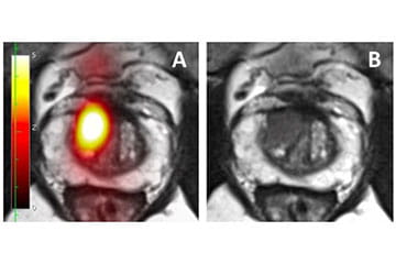 PSMA-PET Screening and Diagnosis
