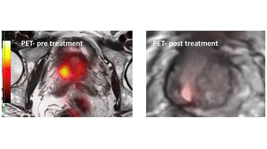 PET pre and post treatment