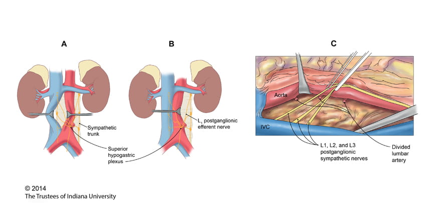 Testicular Cancer Illustration
