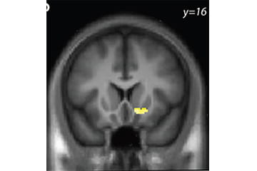 image of a brain scan