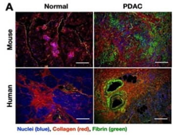 Immunofluorescence micrographs of normal and cancerous pancreas tissues showing collagen, fibrin, and nuclei