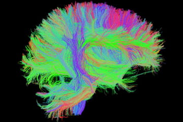 Traumatic Brain Injury Scan